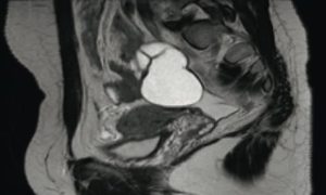 卵管水腫のMRI所見
