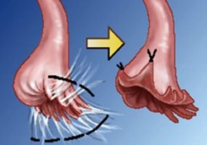 卵管采形成術 卵管采が再び閉鎖しないように切開部卵管を反転固定する