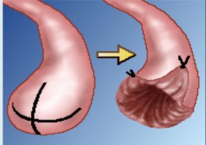 卵管開口術 卵管采が完全に閉じている卵管開口部を開く