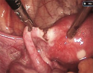 卵管起始部の凝固切断