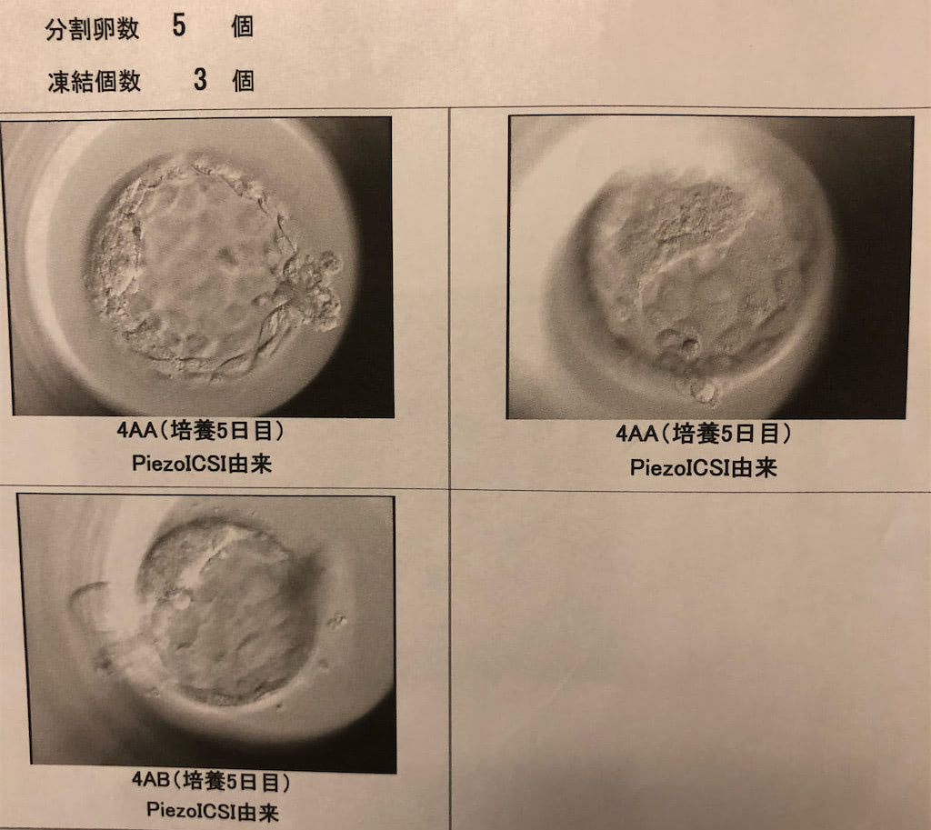 夫婦逆転!?妊活熱高いアラフィフ夫 VS「こっそり飲みに出た」39歳妻 不妊検査と体外受精の結果を聞いてみた | 不妊治療・妊活のクリニック ...