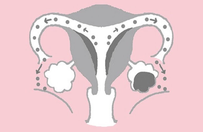 妊娠中の安全な子宮内膜症治療法