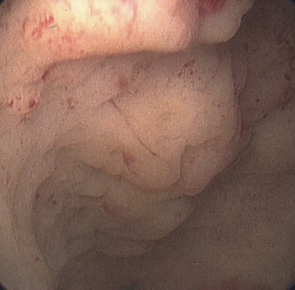 子宮腔右側面の子宮ポリープ