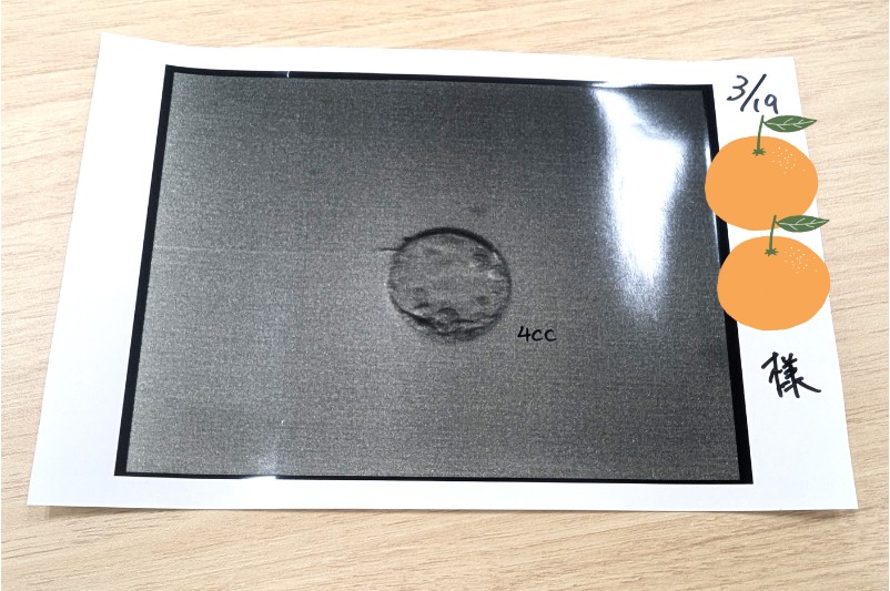 『ママ５年目でがんなんて 手に入れた卵子と失った味覚』